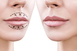 Идеальные губы: как этого достичь